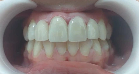 Dentista no Jardim Rina caso 4